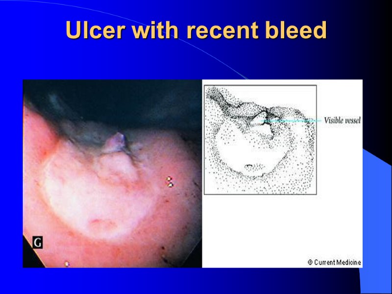 Ulcer with recent bleed